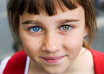 Rare Eye Conditions