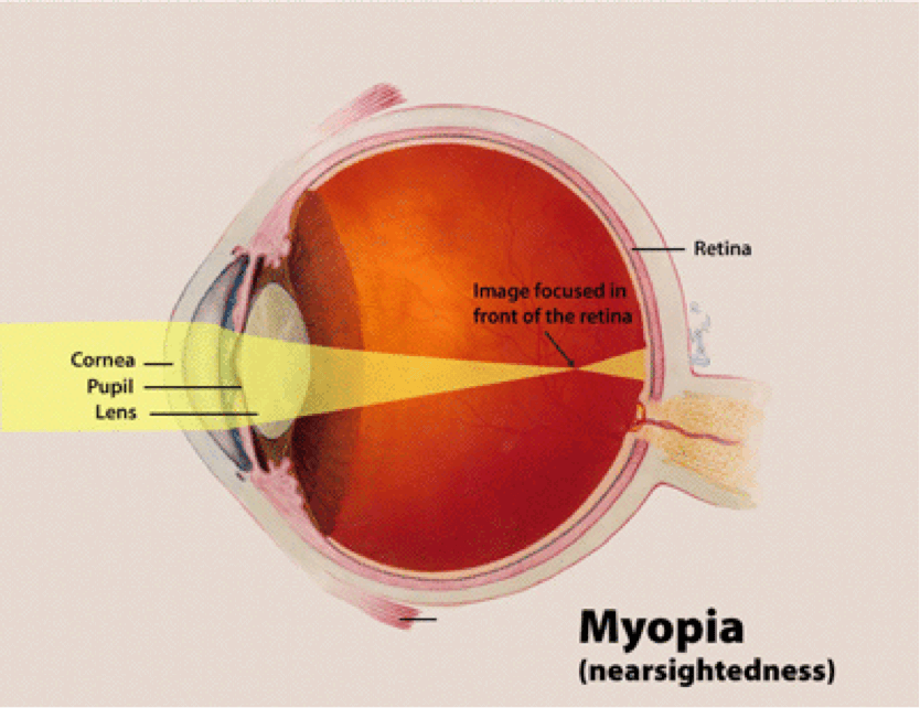 What is Nearsightedness and Farsightedness?