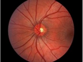Are You at Risk for Macular Degeneration?